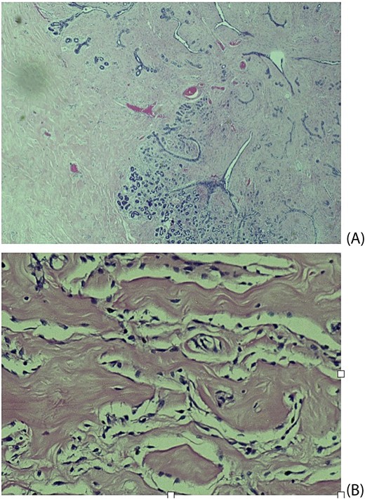 Histological slides showing: (A) Fibroblastic proliferation with cleft like spaces within and adjacent to lobular sclerosing hyperplasia (×20). (B) Cleft-like spaces lined by benign flattened stromal myofibroblasts (×200).