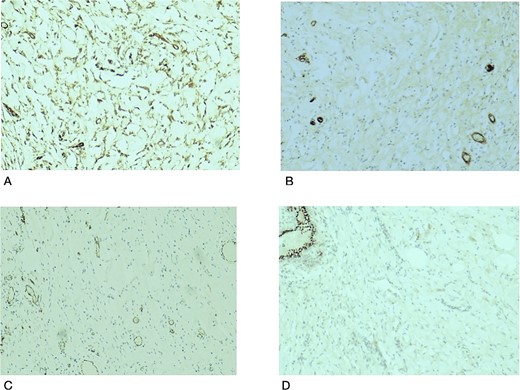 Histological slides showing immunohistochemistry stain expression: (A) Myofibroblasts and endothelial cells showing immune expression for CD34 (×100). (B) CD31 immunostain highlights endothelial cells in blood vessels with no immunoexpression in the stromal myofibroblasts (×100). (C) Factor VIII immunostain of endothelial cells in the blood vessels with no immunoexpression in the stromal myofibroblasts (×100). (D) PR immunostain showing wild type staining in benign breast ducts with no immunoexpression in the stromal myofibroblasts (×100).