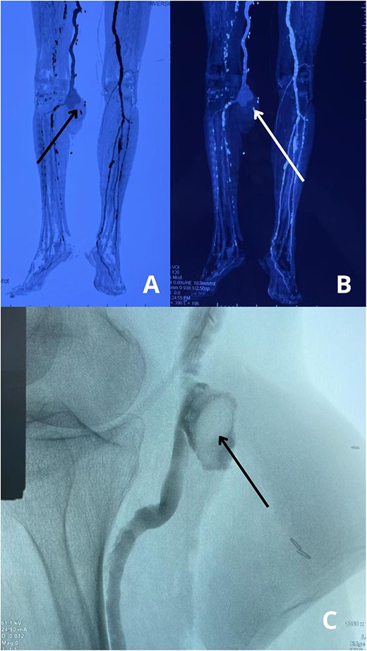 (A) Preoperative view of the right leg, showing swelling, bruising, and discoloration at the site of the popliteal pseudoaneurysm. (B) Intraoperative view displaying the placement of a Gore-Tex graft to restore arterial flow after excision of the pseudoaneurysm.