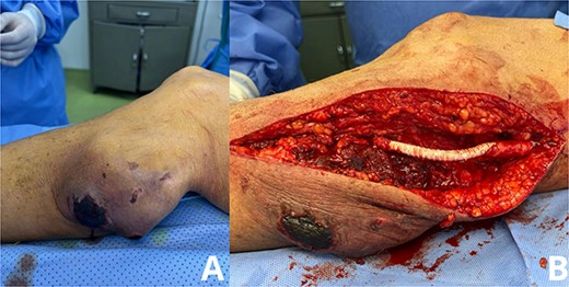 (A, B) CTA scans of the lower extremities reveal a pseudoaneurysm in the right popliteal artery, indicating vascular injury with disrupted arterial flow. (C) Angiographic study shows the pseudoaneurysm sac and confirms a tear in the popliteal artery, with no evidence of distal thrombus or embolization.