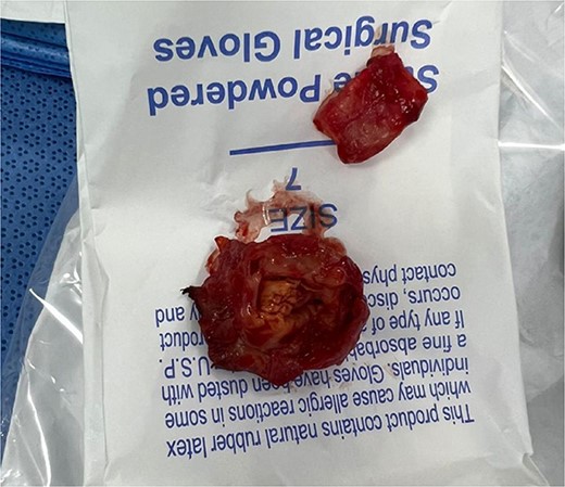 The image shows the excised pseudoaneurysm from the popliteal artery, obtained during surgical intervention. The specimen reveals thickened arterial walls and organized hematoma, indicative of chronic vascular injury.