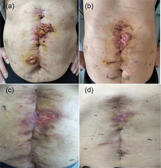PEH lesions. Abdominal scar accompanied by lumps and purulent discharge (a). Follow-up photos taken at 1 week, 1 month, and 1.5 months postsurgery (b, c, d).