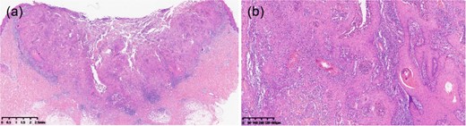 Histopathological examination, Histopathological analysis with hematoxylin–eosin staining (×80) revealed epidermal necrosis and PEH (a). Histopathological analysis with hematoxylin–eosin staining (×400) demonstrated inflammatory cell infiltration without cytological atypia (b).
