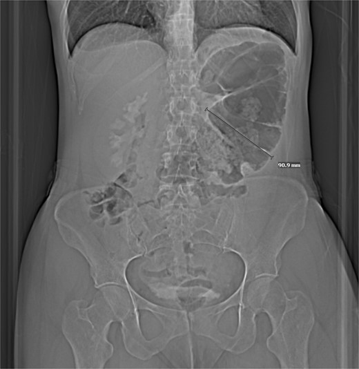 CT w/out contrast reveals focally dilated loop of transverse colon.