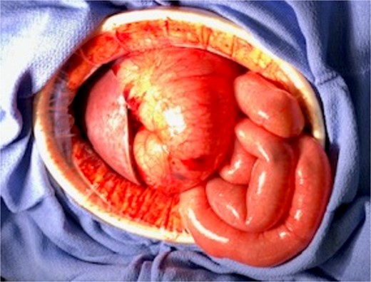 At laparotomy, distended loop of transverse colon with closed-loop obstruction.