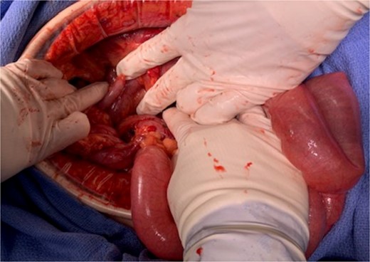 Delivering the ileum, appendix and cecum through the FoW.