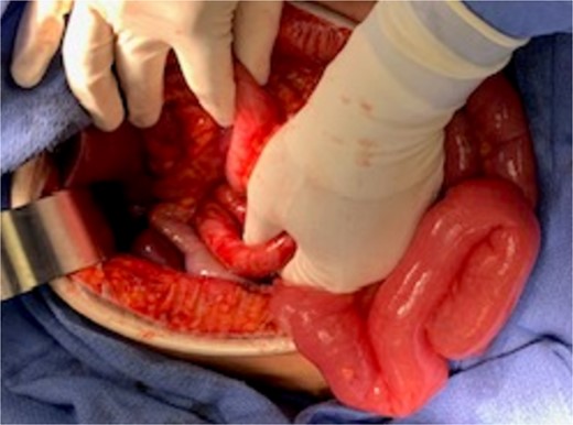 Reducing the ileum and colon through FoW.