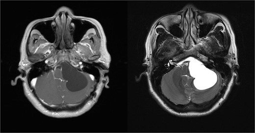 MRI examination reveals an extra-axial cystic lesion appearing dark on T1-weighted images and bright on T2-weighted images.