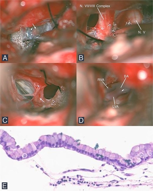 Intraoperative and histopathological findings. (A) The cyst wall is seen adhering to the arachnoid layer in the CPA (arrow). (B) During dissection, the N. VII/VIII complex and N. V are visualized. Structures observed include (C) the lower cranial nerves with the arachnoid and cyst wall (arrow) and (D) the vertebrobasilar junction. (E) Microscopic examination shows a columnar epithelium with goblet cells (HE stain; 100× magnification). (Abbreviations: CPA: Cerebellopontine angle, N: Nerve, V: Trigeminal, VII: Facial, VIII: Vestibulocochlear, RVA: Right vertebral artery, LVA: Left vertebral artery, BA: Basilar artery, HE: Hematoxylin and eosin stain).
