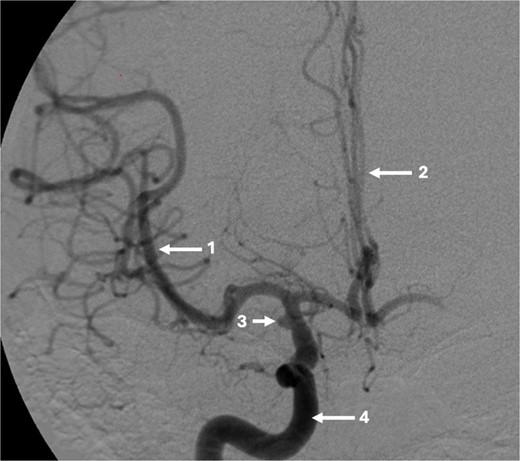 Pre-operative CT angiogram demonstrates normal appearances of the (1) MCA, (2) ACA with, (3) laterally projecting terminal carotid sidewall aneurysm. (4) R ICA.