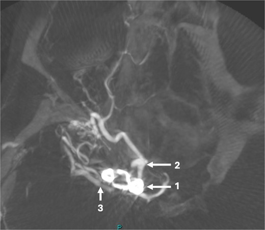 Axial post-operative CT angiogram demonstrating the (1) encircling clip occlusion of the terminal internal carotid artery aneurysm with a relatively normal calibre of (2) A1 and, (3) M1.