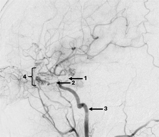 Sagittal DSA demonstrating (1) Clip is in position across the terminal carotid. The frontal branch of the right MCA is supplied by collaterals from the (2) right ophthalmic artery (hypertrophied recurrent meningeal artery), right middle meningeal artery and right superficial temporal artery (via craniotomy site as pial synangiogenesis). There is collateral vessel formation consistent with Moyamoya phenomenon (4). (3) ICA. The A1 is not opacified likely due to the anterior communicating (ACOM) collateralisation.