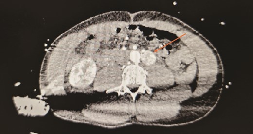 Contrasted CT in arterial phase, in the axial plane, showed a contrast enhanced, hyperdense, heterogenous lesion located over the left para-aortic region, measuring ⁓2 × 2 × 3 cm with no septations or peripheral rim enhancement.