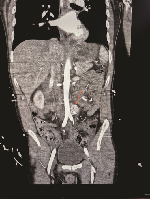Contrasted CT of the abdomen and pelvis in arterial phase, coronal plane, revealed a similar mass, contrast enhanced heterogenous lesion with well demarcated borders, measuring ⁓2 × 2 × 3 cm, situated at the left para-aortic region.