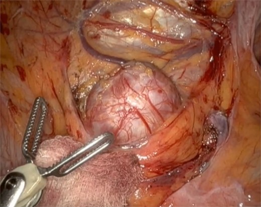 Well circumscribed mass with extensive vascularisation is located and isolated, with no surrounding tissue necrosis or invasion observed. Real time video footage revealed a pulsatile mass.