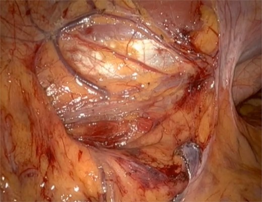 Post tumour removal showed clean base with no active bleeding. No evidence of tissue invasion into peripheral structures.