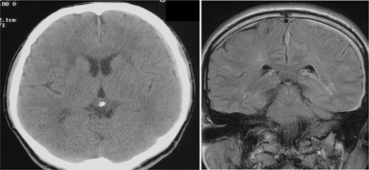 CT (left) axial image of the brain and MRI (right) fluid-attenuated inversion recovery coronal image from the referring hospital. SDH is visible on both images, without evidence of SAH. SDH is also visible in the interhemispheric fissure on MRI.