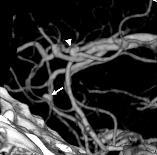 Lateral view (left to right) of three dimensional CT angiography taken at our clinic, showing cerebral aneurysm in the ACA of right A2A3 (white arrow) and left A3A4 (white arrow head).