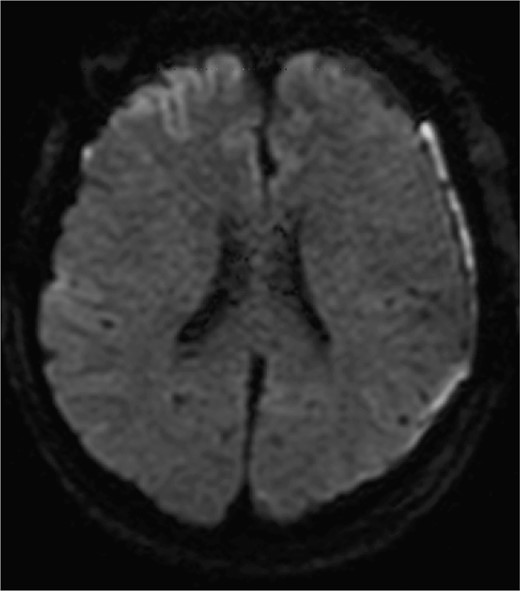 Diffusion-weighted images on postoperative day 3 are shown. No obvious ischemic changes are seen.