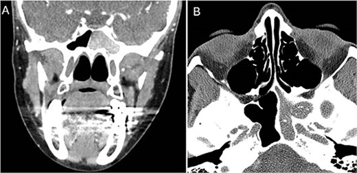Coronal (A) and axial (B) images of a nonenhanced CT scan of the paranasal sinuses showing left sphenoid sinus complete homogenous opacification.