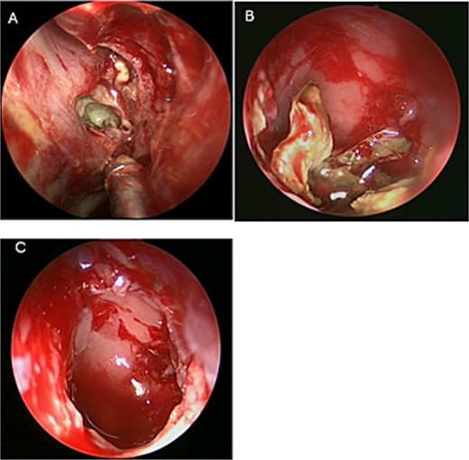 Intra-operative (A and B) endoscopic sphenoidotomy showing fungal debris, with post-operative examination (C) showing clean wide sphenoid sinus free from fungal debris.