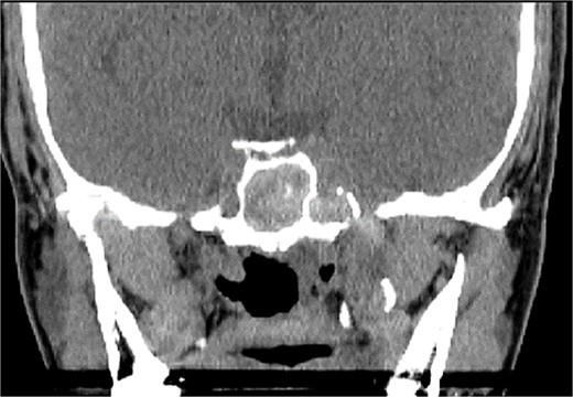 Coronal CT scan image showing complete sphenoid sinus heterogenous opacification.