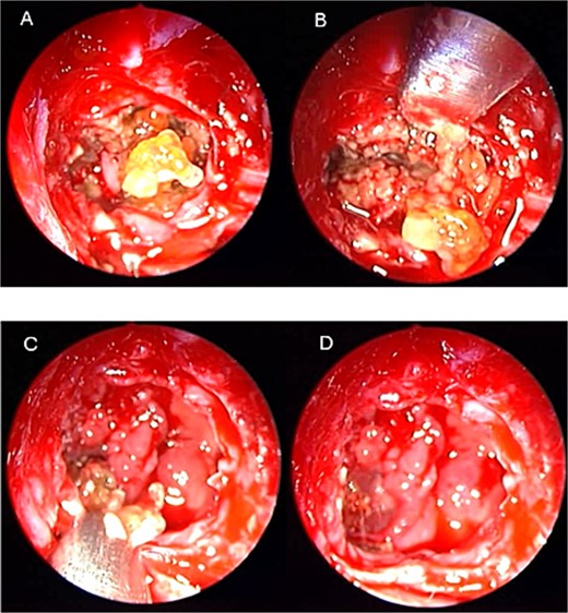 Intra-operative (a, b, and c) endoscopic sphenoidotomy showing mud and mucin, with post-operative examination (d) of right optico-carotid recess showing wide and clean sphenoid sinus.