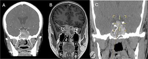 Coronal CT (A) and MRI (B) and CT image guided intra-operative (C) images of the paranasal sinuses showing aggressive sphenoid sinus disease extending to the skull base and cavernous sinus.