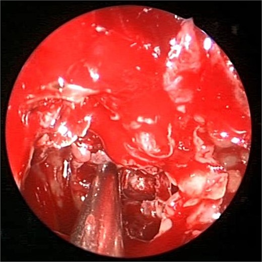 Intra-operative endoscopic view of shenoid sinus debridement of invasive fungal disease.