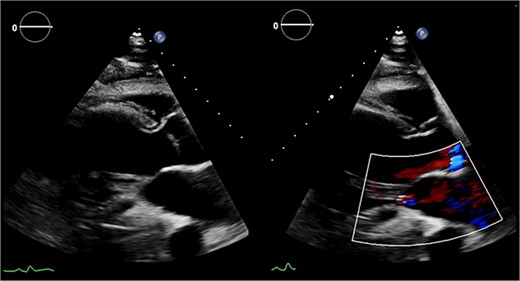 Preoperative echocardiography: large LV aneurysm below the posterior mitral valve leaflet tethering it open in systole resulting in severe functional mitral regurgitation.