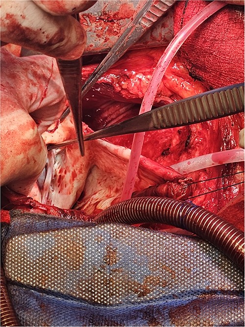 The LV aneurysm was resected down to its neck into healthy ventricular scar tissue. The posterior chordae can be seen from the ventricular defect.