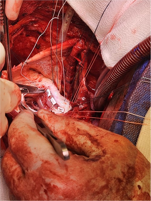 Pledgeted Ethibond sutures were placed circumferentially around the aneurysm mouth.
