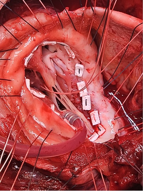 Once the sutures for the patch were placed, the two papillary muscles were identified and another pledgeted suture through the musculotendinous junction was used to approximate them.