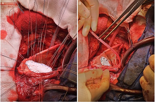 A: The patch was parachuted down and secured. B: Following this the aneurysm sac was closed over the patch for added haemostasis.
