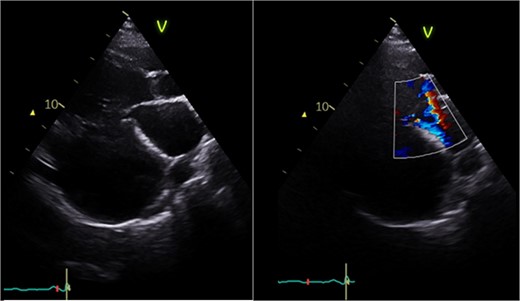 Postoperative echocardiography: restoration of mitral valve leaflet coaptation and LV geometry, resulting in trivial regurgitant jet.