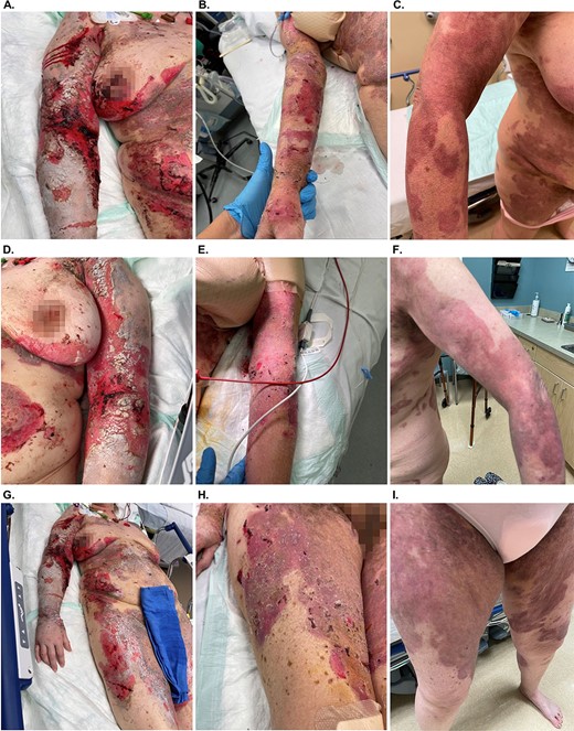 Treatment of PV with OFM graft to the upper right extremity (A–C), upper left extremity (D–F) and right thigh (G–I). Image sets show progression at treatment initiation (A, D, and G), at 1 week post application of OFM (B, E, and H) and at 4 weeks post application of OFM (C, F, I).