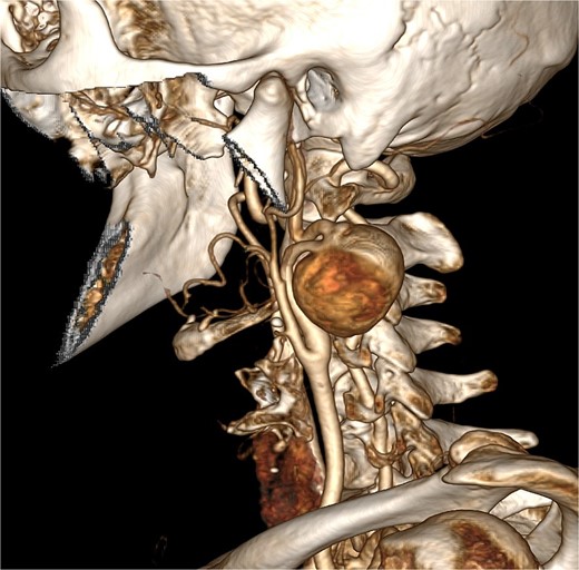 The carotid aneurysm located at the internal carotid artery and compressed the C1 segment, emanated from the distal end of the C1 segment at an angle of 90°, and the distal end of it formed three more 90° angles then traveled upward to the C2 segment. The anatomical characteristics of the aneurysm indicated that the endovascular repair was impossible.