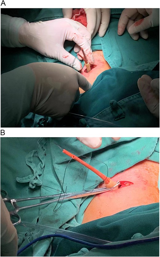 (A) Following routine disinfection and sterile draping, local anesthesia was injected, a transverse 3 cm incision was made ⁓2 cm above the sternal notch along the dermatome of the left neck. After the exposure of the left common carotid artery, an 8-French catheter was looped around the common carotid artery, with the tail of the catheter passed through the incision in a vertical orientation. (B) A short section of the T-tube was attached to the external part of the catheter and secured to prevent loosening. Upon tightening the catheter, aneurysm pulsation ceased, indicating successful blockage, and pulsation returned upon loosening the catheter, the platysma and skin were sutured.