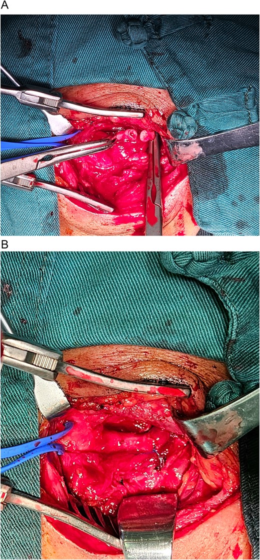 (A) After systemic heparinization with systemic heparin injection and clamping of the distal C1 and proximal C2 segments, the aneurysm was completely resected, resulting in a successful anastomosis. (B) An in situ internal carotid artery-to-internal carotid artery anastomosis was performed, demonstrating no blood leakage and strong distal pulsation.