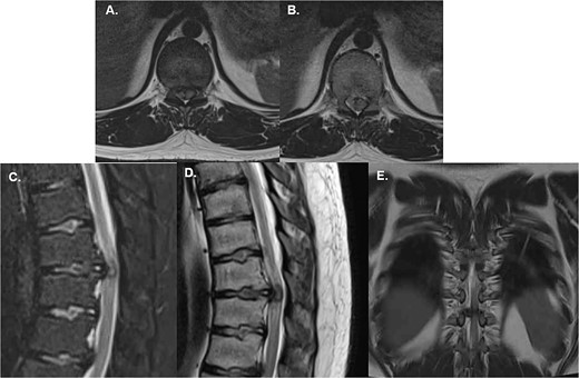 Emergency MRI of the patient shows (A) and (B) axial T2W projections that demonstrate a severe compression of the spinal cord given the central location of the extruded disc, (C) a sagittal T2W with fat suppression allows to see the extruded disc nucleus of the T10-T11 disc causing compression of the spinal cord; edematous changes are also visible, (D) shows a T1W sagittal midline image of the extruded disc which also shows a flattened spinal cord with associated edema; note the absence of any calcification or changes associated with chronic progression and (E) is a coronal T2W image of the disc herniation showing its central location with a slight predominance over the right canal.