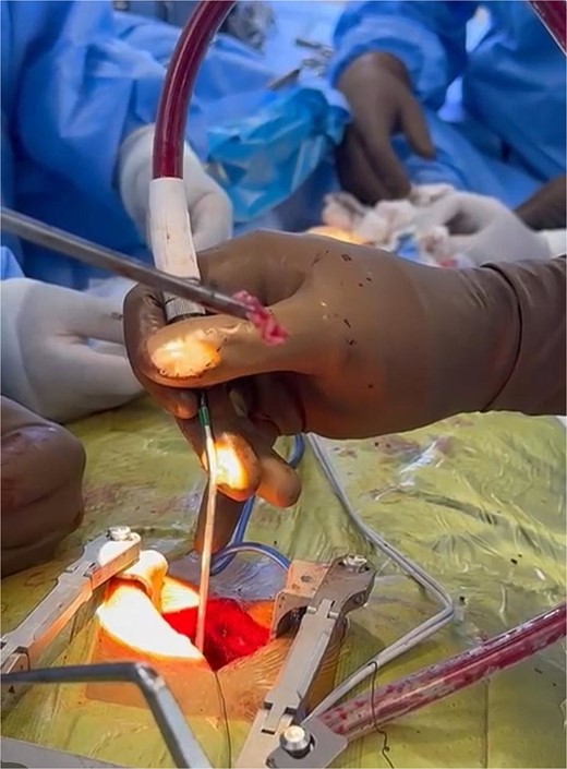 Intraoperative image of the herniated material removed from the spinal canal.