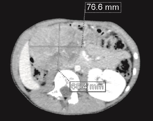 CT scan: A solid mass of 9 × 6 cm of diameter containing some areas of necrosis, well circumscribed, well encapsulated at the expense of the right kidney in contact with the cephalic portion of the pancreas and in close contact with the inferior vena cava, which is pushed to the left. The right kidney is not visualized.