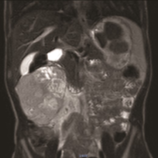 MRI: A solid mass in the upper right of the abdomen without visualization of normal right kidney parenchyma.