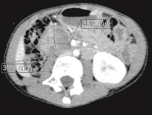 CT scan evaluation after chemotherapy: Regression in size of the right kidney mass with an estimated response of 75%.