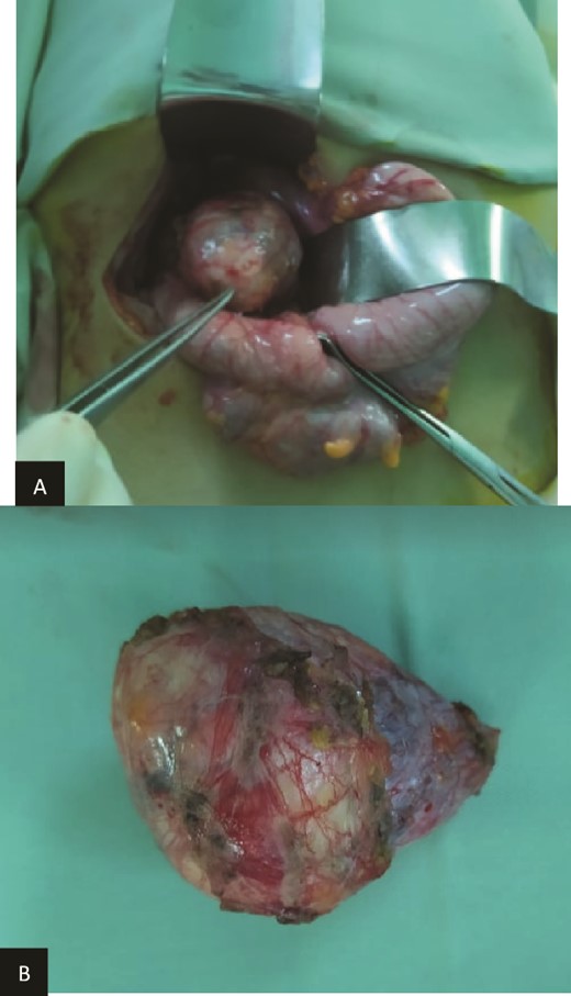 (a) Preoperatively finding. (b) Macroscopic aspect of the tumor.