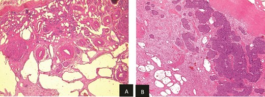 (a) Viable nephroblasma with blastemal and epithelial component (HE × 40). (b) Non-tumoral kidney tissue showing lesions of MCDK disease (HE × 40).