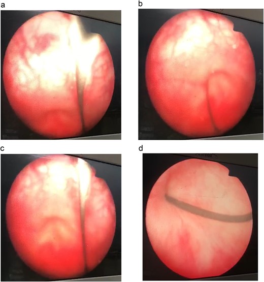 Antegrade urethroscopy.