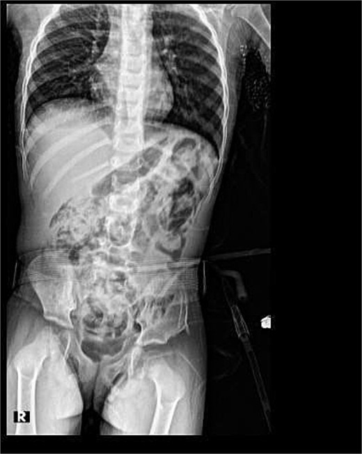 Post-operative X-ray.