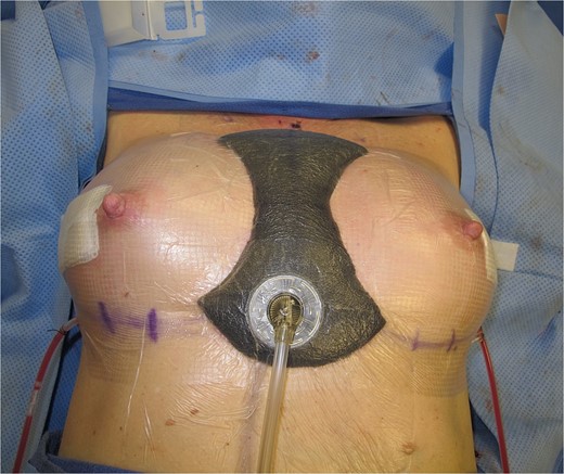 Photo of negative pressure wound device compressing the intermammary sulcus after surgical correction of symmastia.