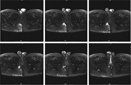 Preoperative perianal MRI.